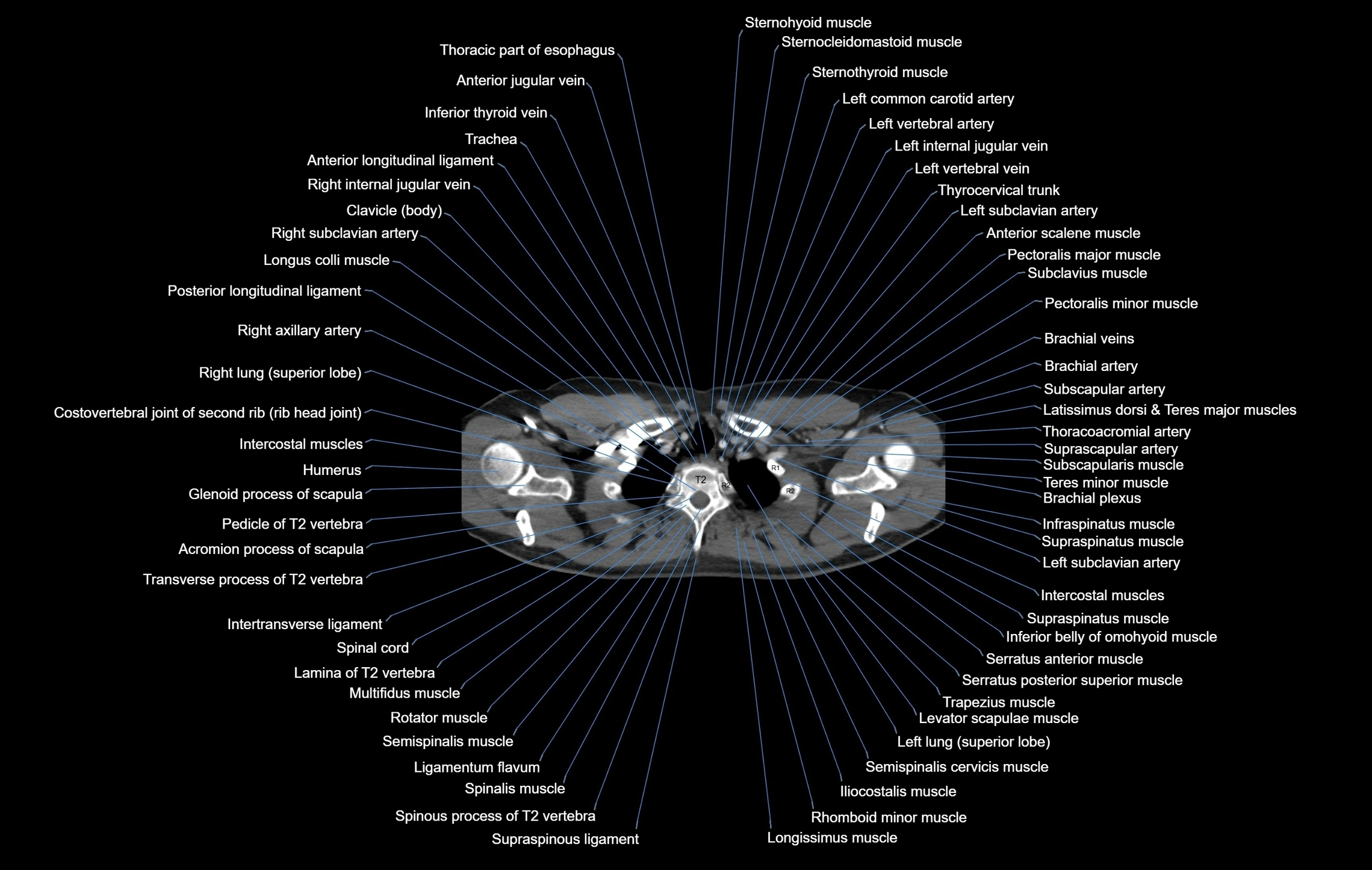 CT chest (thorax) labelled axial cross sectional anatomy radiology image-00010.webp
